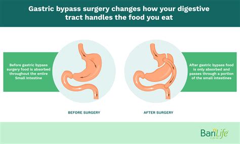 rates can you reverse the gastric sleeve
